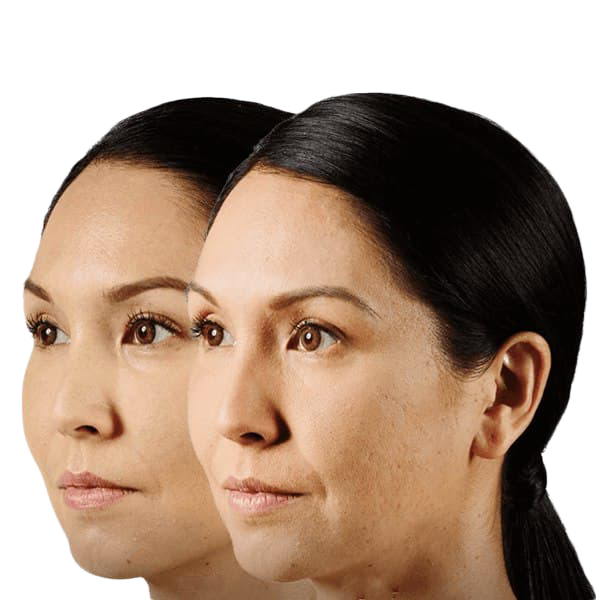Juvederm NYC - Facial Filler