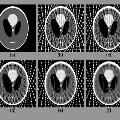 多項政府補助助力,我國開發出低滲漏骨水泥灌注系統