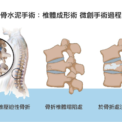 聯創愛凱福骨水泥取得 TFDA 二類核准