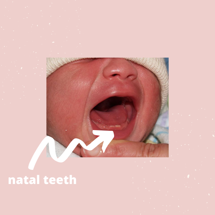 Natal teeth