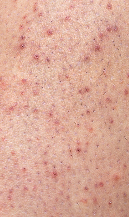 A close-up of the razor on the legs.