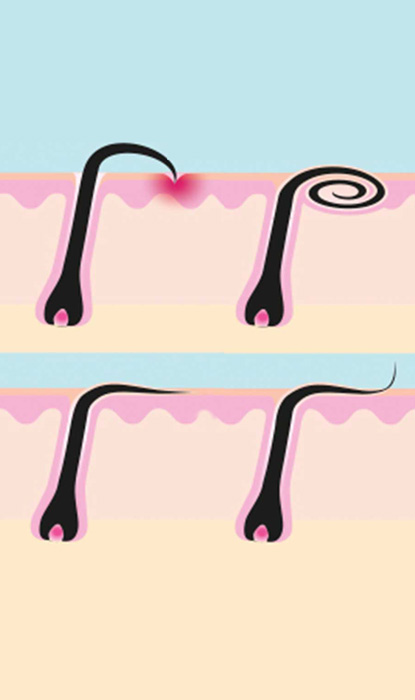 Ingrown hair illustration