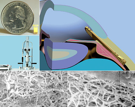 SOLX DeepLight Glaucoma Treatment System