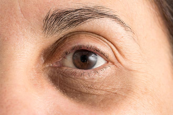 Ojo con ojos hinchados y oscurecidos