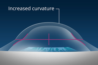 curvature of cornea during ck surgery