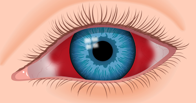 Illustration of blood in the eye
