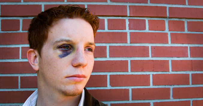 man with black eye