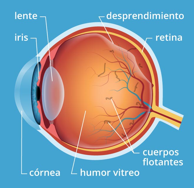 el vítreo se licúa con la edad y se separa de la retina.