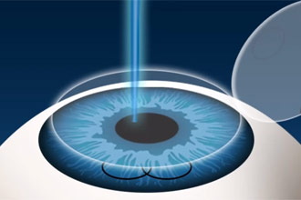 illustration of excimer laser ablation