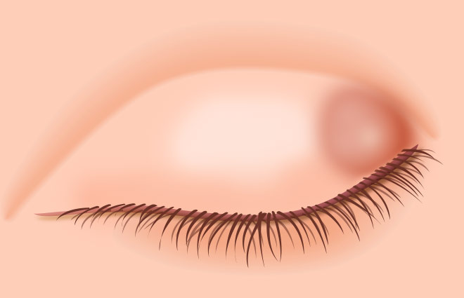 chalazion