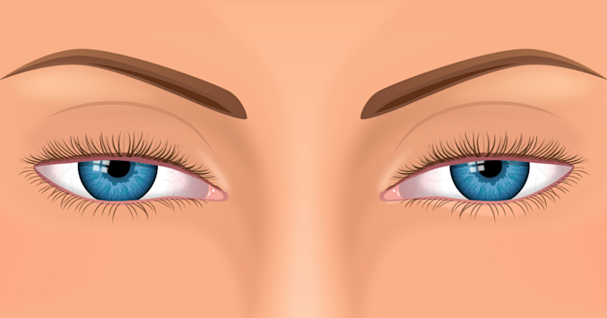 Droopy eyes