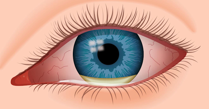 illustration of infected eye