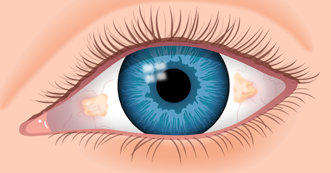 eye with pinguecula