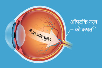 Illustration of intraocular pressure in the back of the eye - Hindi