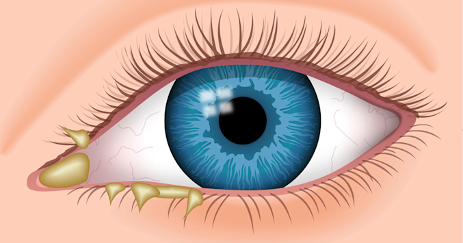 illustration of eye discharge