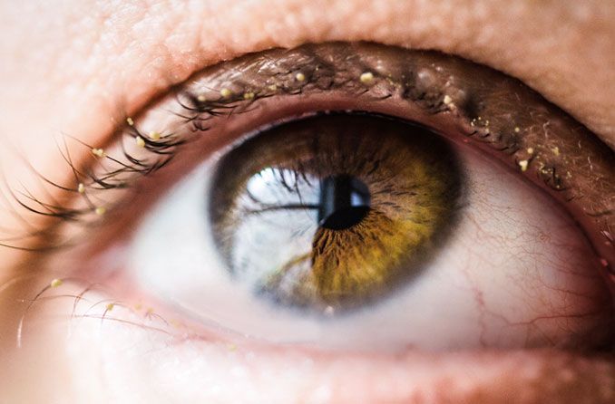 A closeup of an eye with conjunctivitis