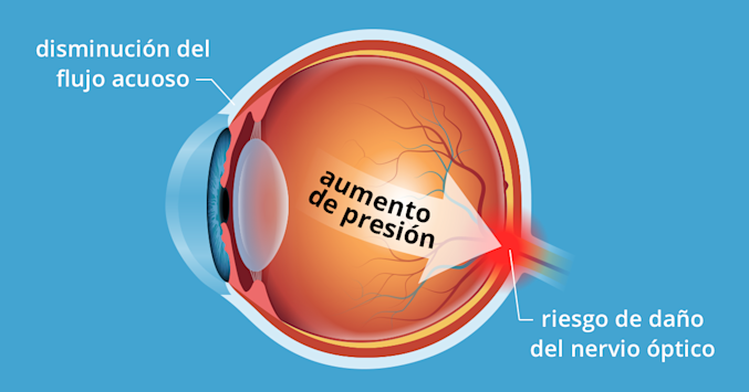 Ilustración del globo ocular y cómo la presión ocular elevada puede causar daño al nervio óptico