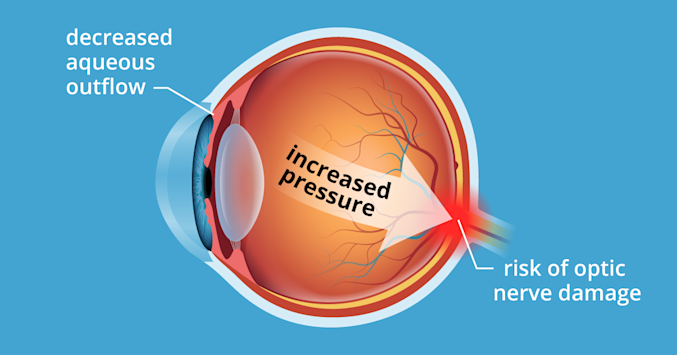 illustration of ocular hypertension