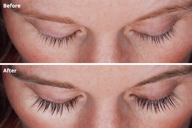 before and after Latisse treatment for longer lashes
