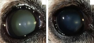 Cataract Surgery eye drops
