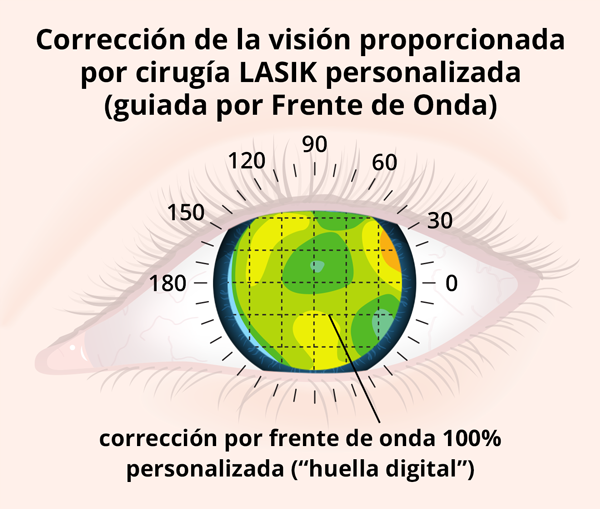Corrección de la visión proporcionada por cirugía LASIK personalizada