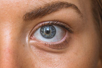 Droopy eyelid surgery photo