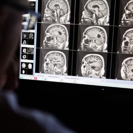 Der Arzt Florian Kunz betrachtet MRT-Bilder des Kopfs eines Patienten.