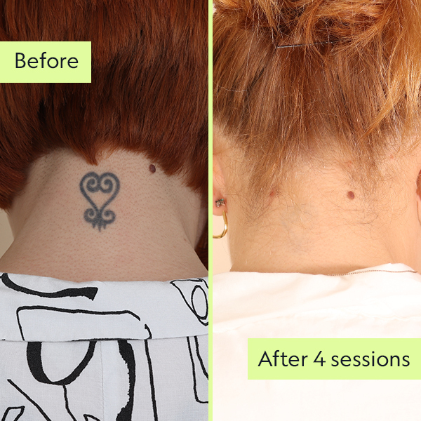 Laser tattoo removal work after 4 sessions