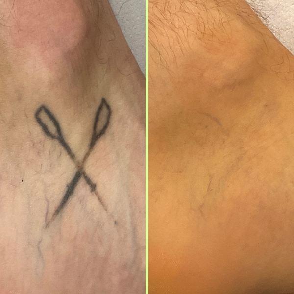 Foot tattoo removal