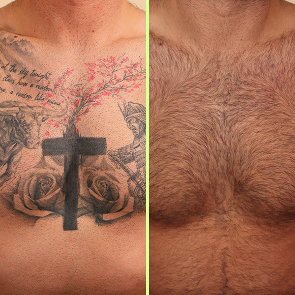 Aston's chest tattoo removal results - before & after photos