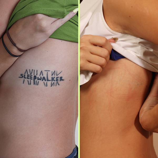 Fiona's ribs tattoo removal results photo