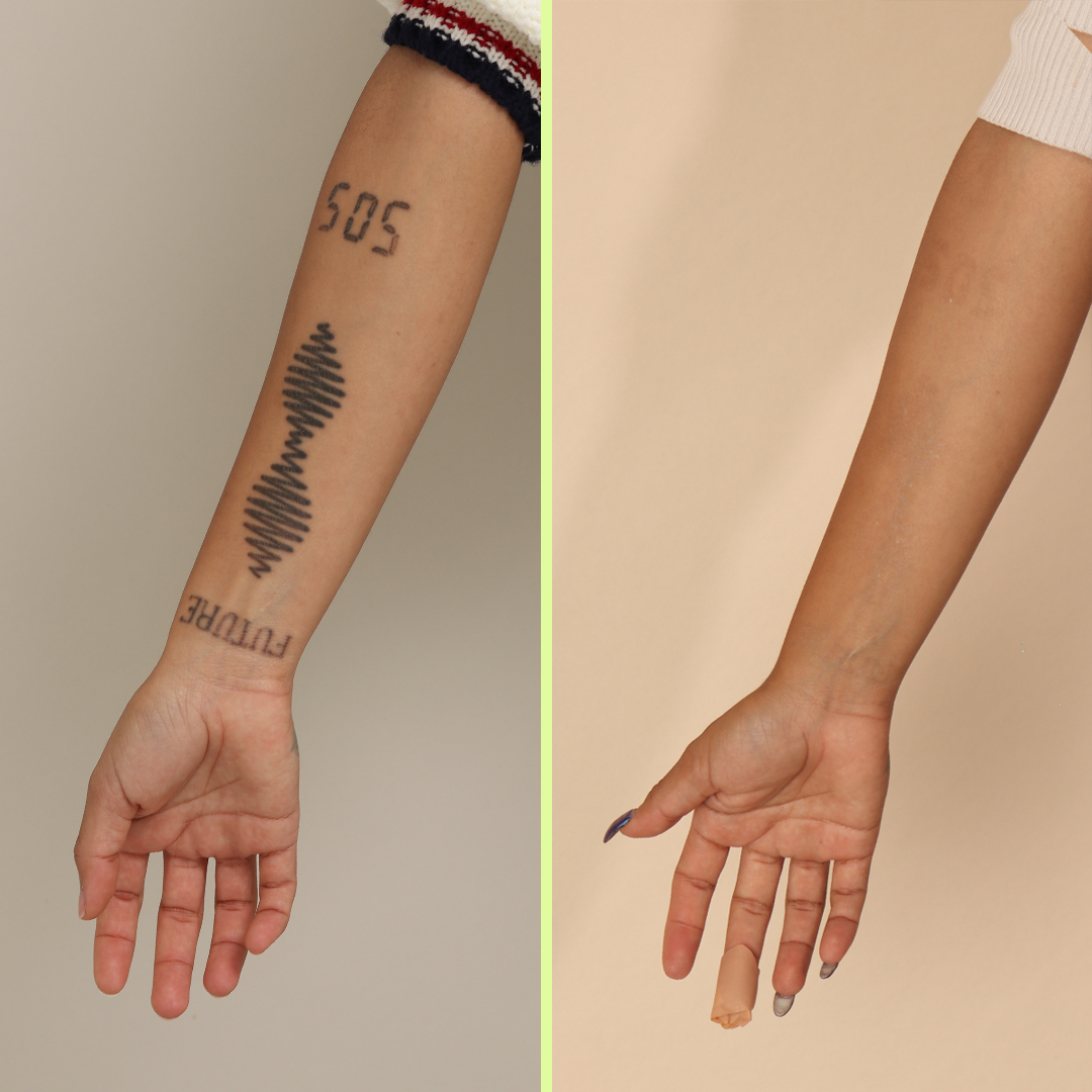 Forearm tattoo removal