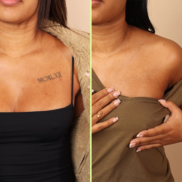 Chest tattoo removal