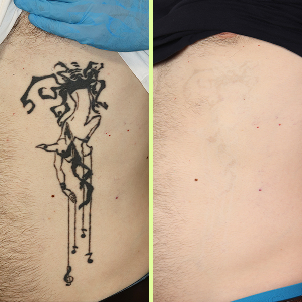 Before and After Tattoo Removal Jarrod