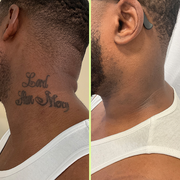 Neck tattoo removal