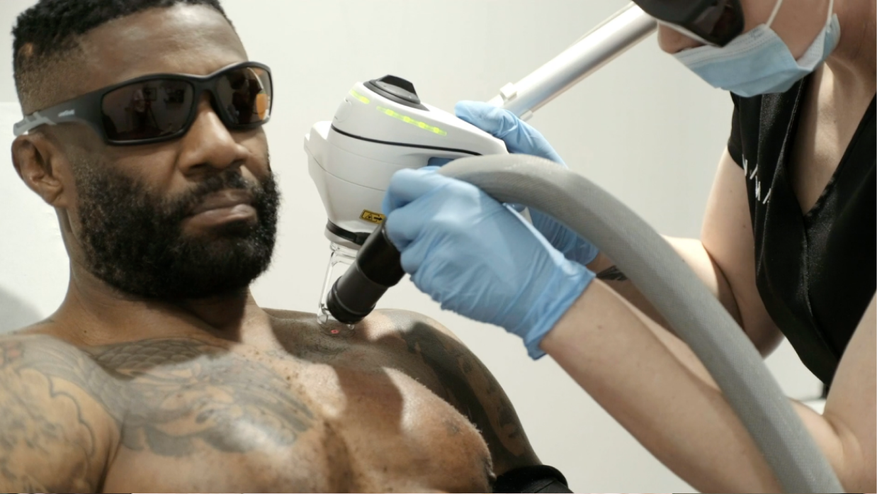 Tattoo lover Carl immediately regretted a large tattoo he got on his chest. He came to NAAMA to fade his tattoo so that he could get it covered effectively with a new design. He found NAAMA’s treatment “a dream” compared to older, more aggressive technologies.