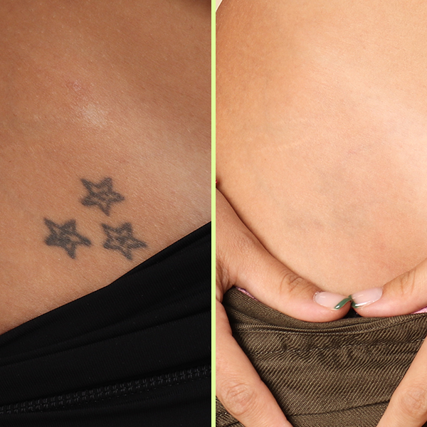 Hip tattoo removal