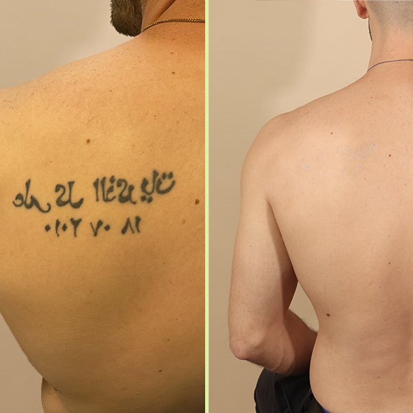 Shoulder tattoo removal