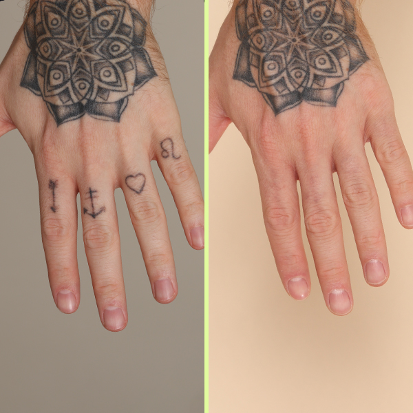 Fingers tattoo removal