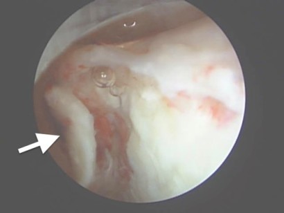 Figure 2: Arthroscopic view at surgery of a bone fragment (arrow) and cartilage damage in the middle carpal joint (knee).