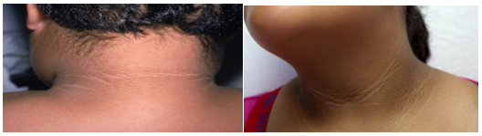 Acanthosis Nigricans Acanthosis Nigricans