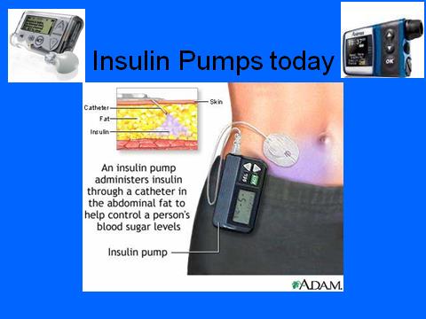 Insulin pumps today