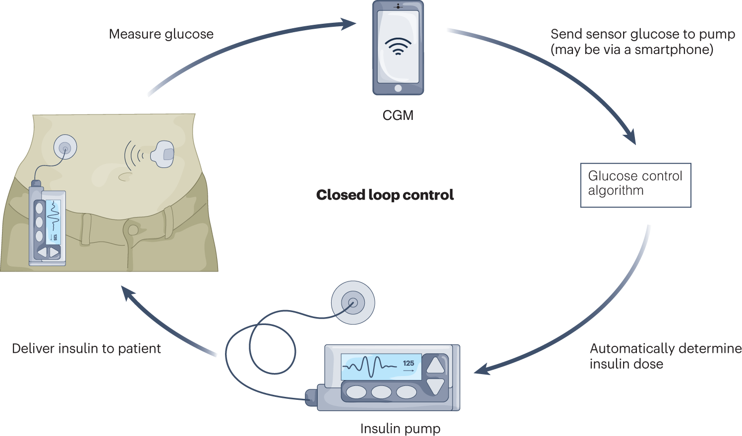 pump picture AID(automated insulin delivery) pump picture AID(automated insulin delivery)