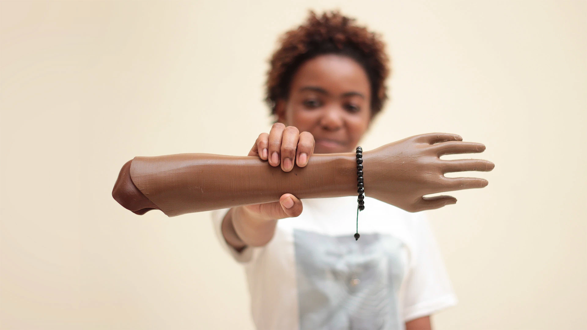 The pressing need for prosthetics