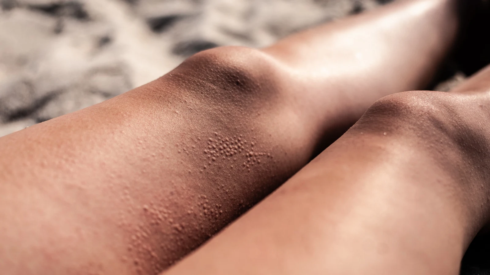 Legs covered in rash