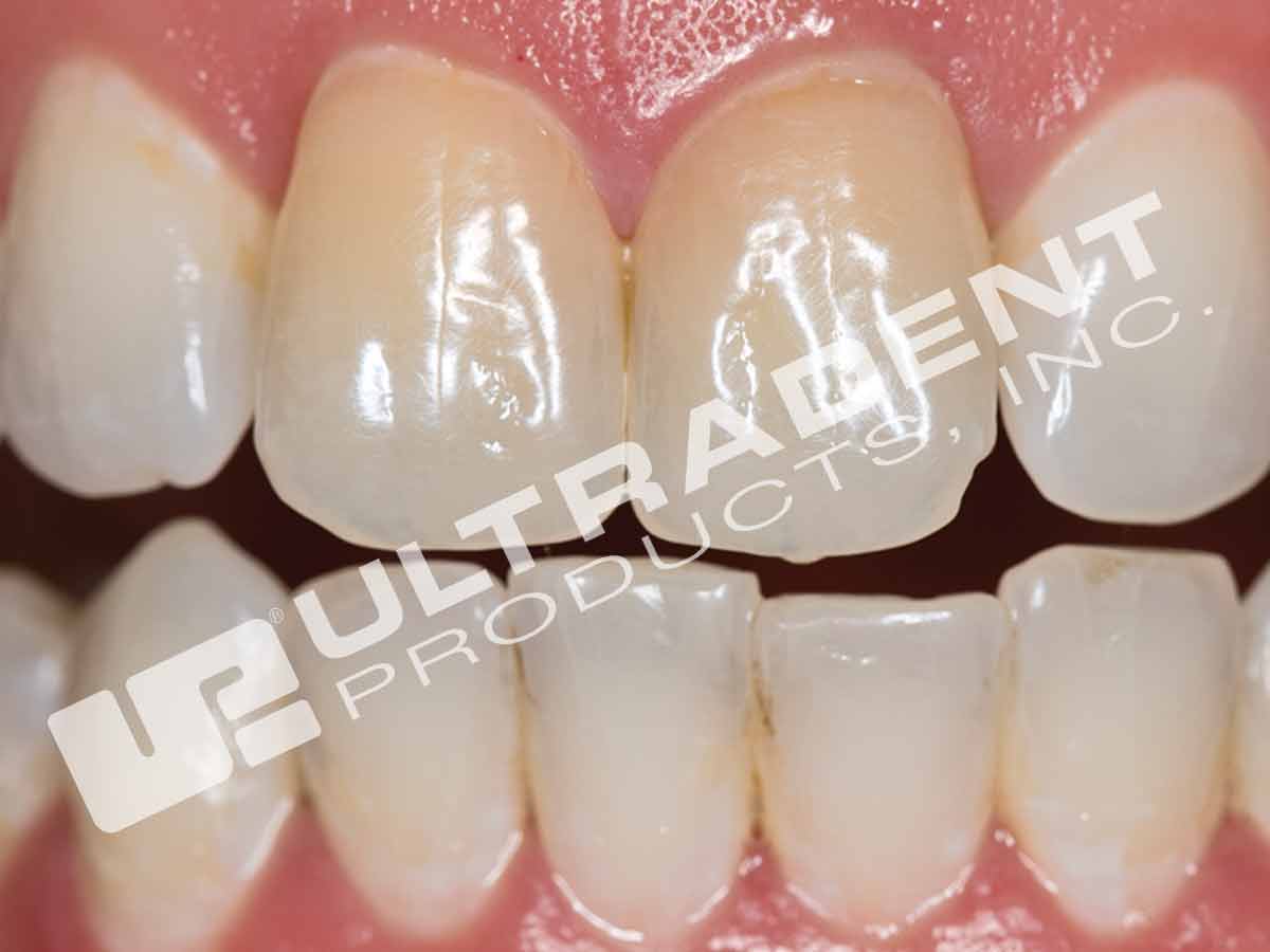 Opalescence Endo