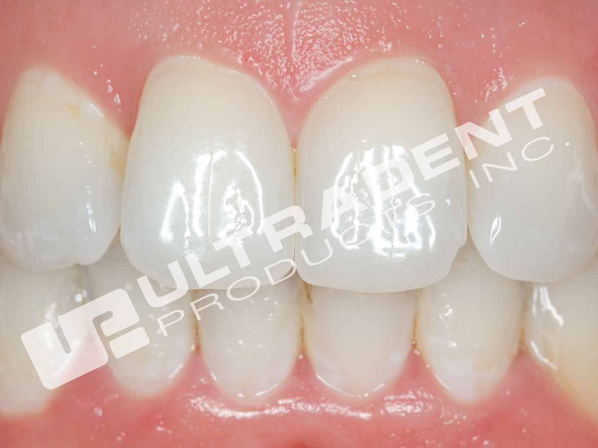 Opalescence Endo