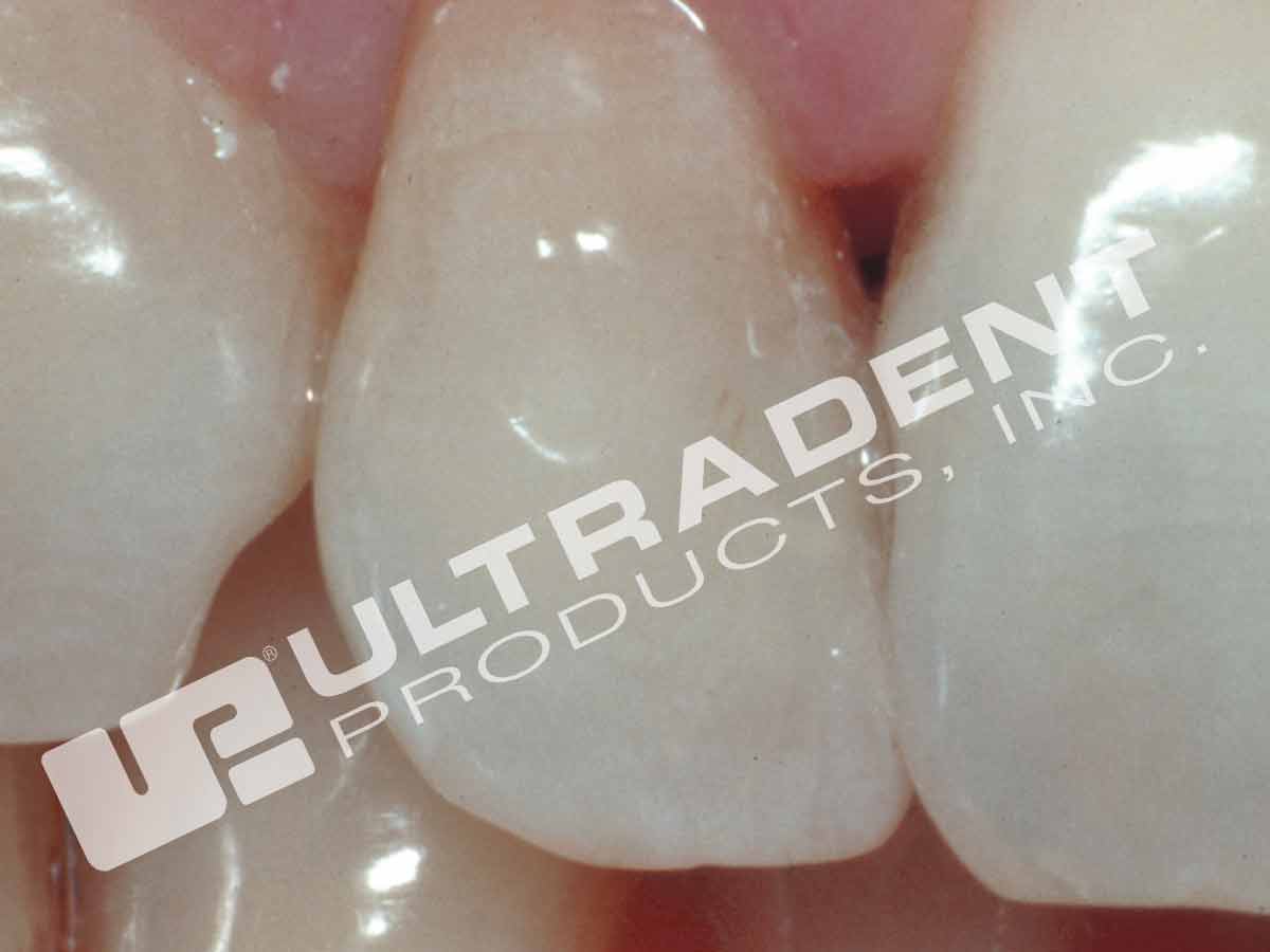 Opalescence Endo