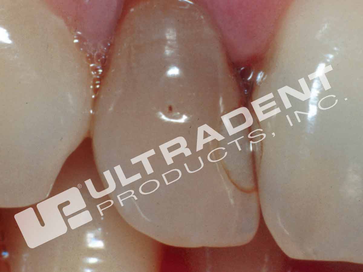Opalescence Endo