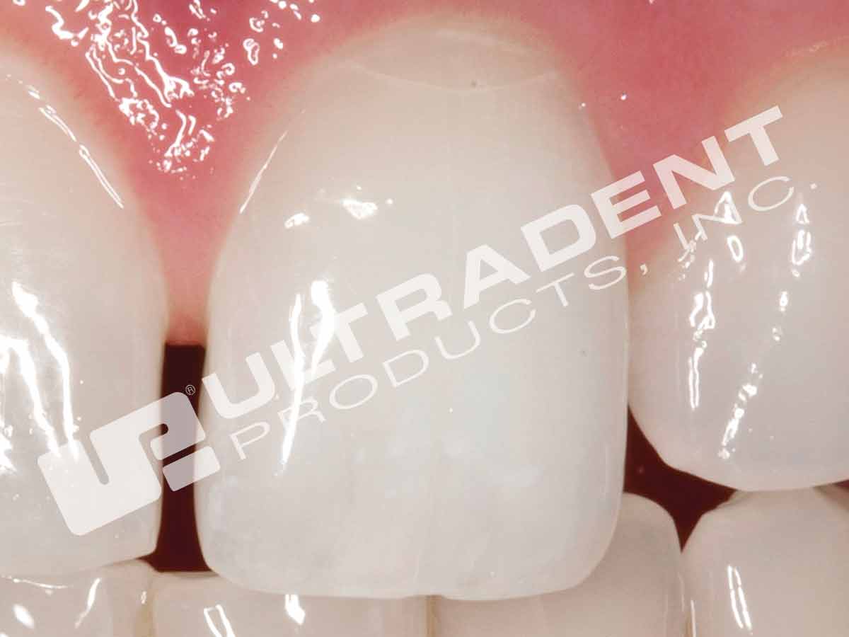 Opalescence Endo